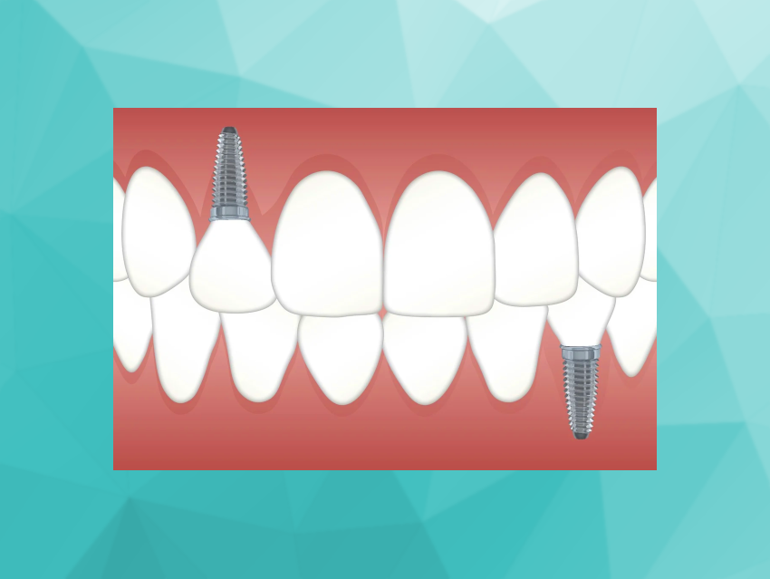 Carbon-Nanohorn-Based Material against Inflammation around Dental Implants