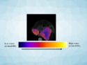 MRI-Based Method Measures Tumor Malignancy