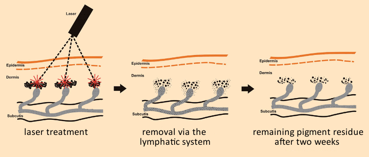 Tattoo removal by laser