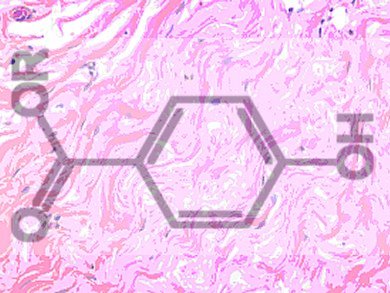 Parabens in Breast Tissue