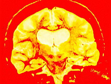 Repeated Stress Causes Cognitive Impairment