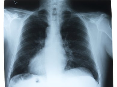 Two-Drug Combination for Treating Tuberculosis
