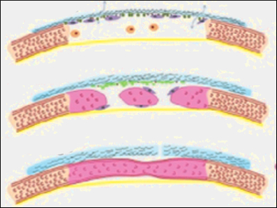 Graphene Hydrogel Membranes Guide Bone Regeneration