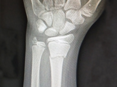 Nanosheet Gel Helps Broken Bones