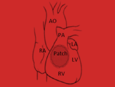 Better Patches for Heart Repairs
