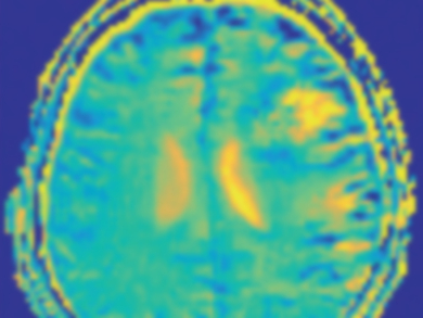 Glucose‐Enhanced Magnetic Resonance Imaging