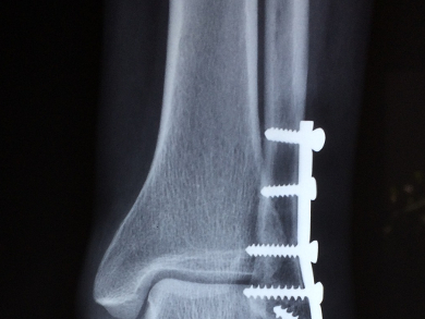 Treating Infected Bone Implants with Phosphorus