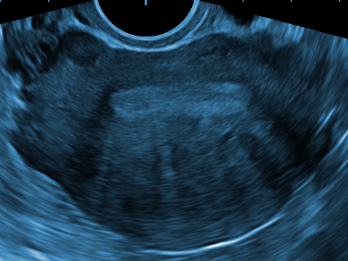 Loaded Nanoparticles as Ultrasound Contrast Agents