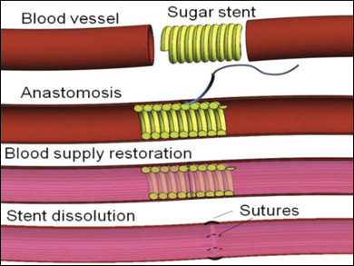 Sugar-Based Stents Help Connect Blood Vessels