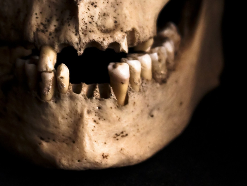 Improved Analysis of Calcified Plaque from Ancient Teeth